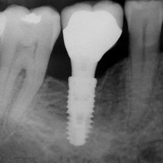 Radiografía de un implante dental colocado entre dos piezas