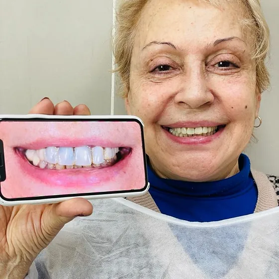 Paciente sonriendo con babero descartable, sosteniendo un celular con la foto de su sonrisa terminada