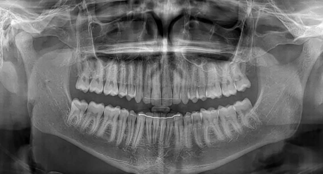 Radiografía de ejemplo: las dos arcadas completas, con todas las piezas sanas y en su lugar